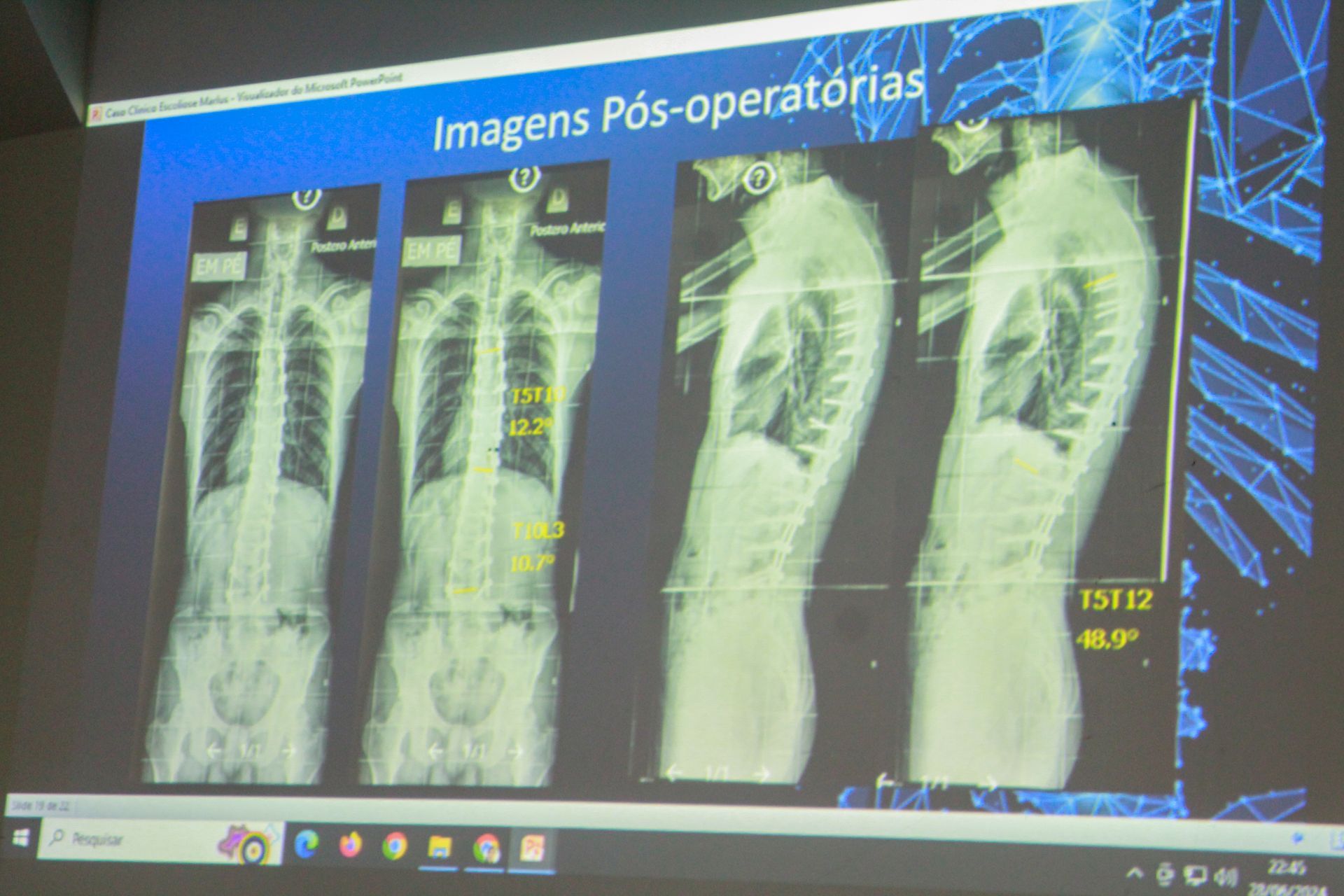 Uma radiografia do tórax de uma pessoa com escoliose.