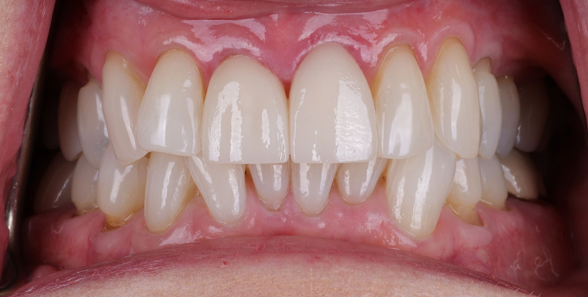 Before and after image of smile 