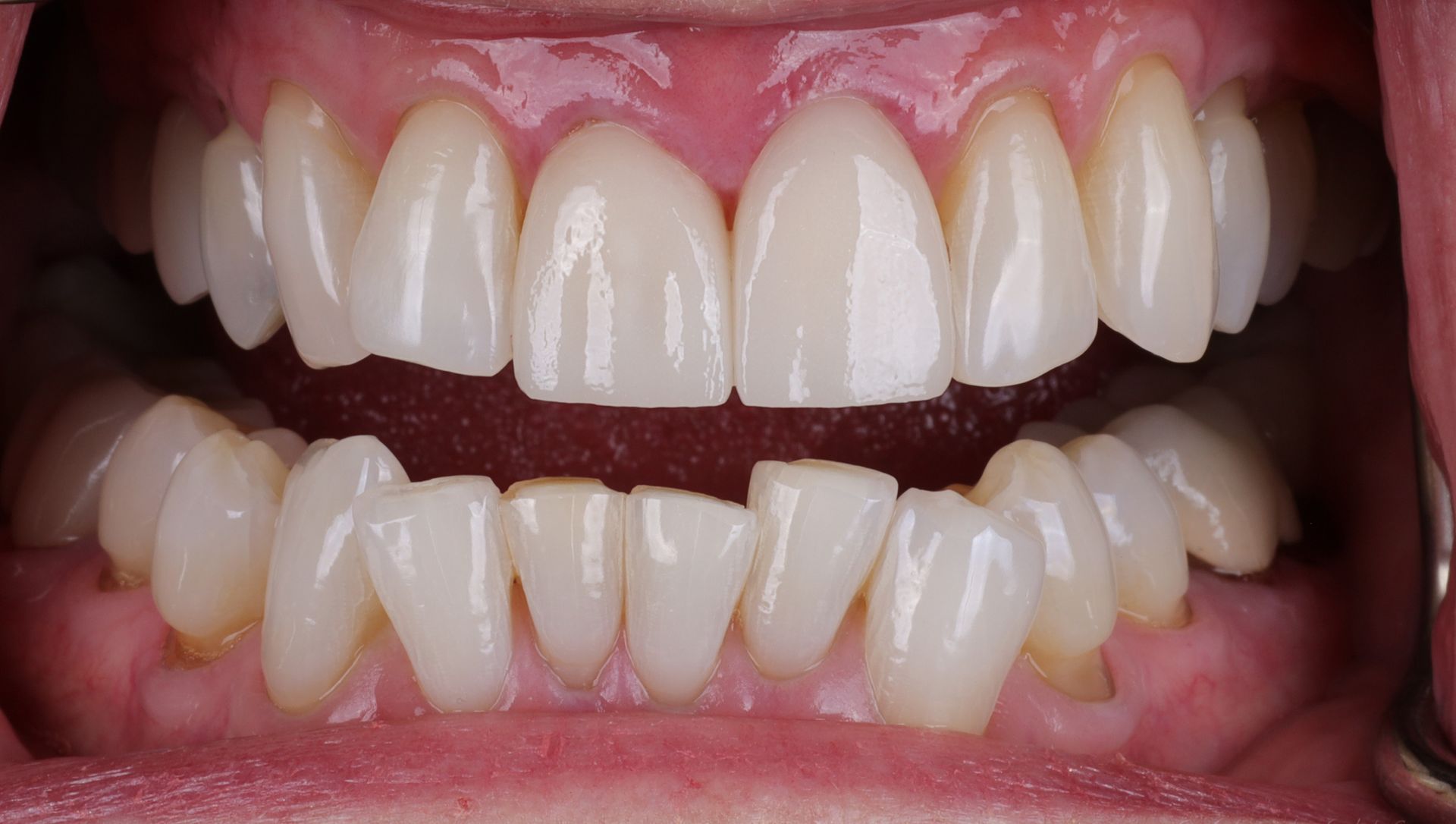 Before and after image of smile 