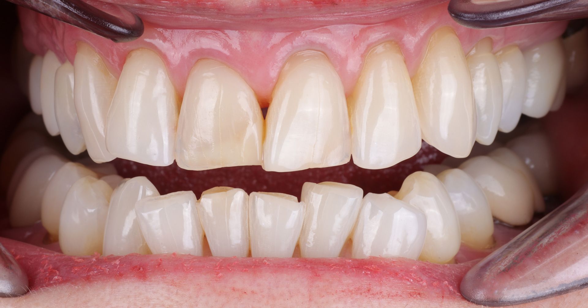 Before and after image of smile 