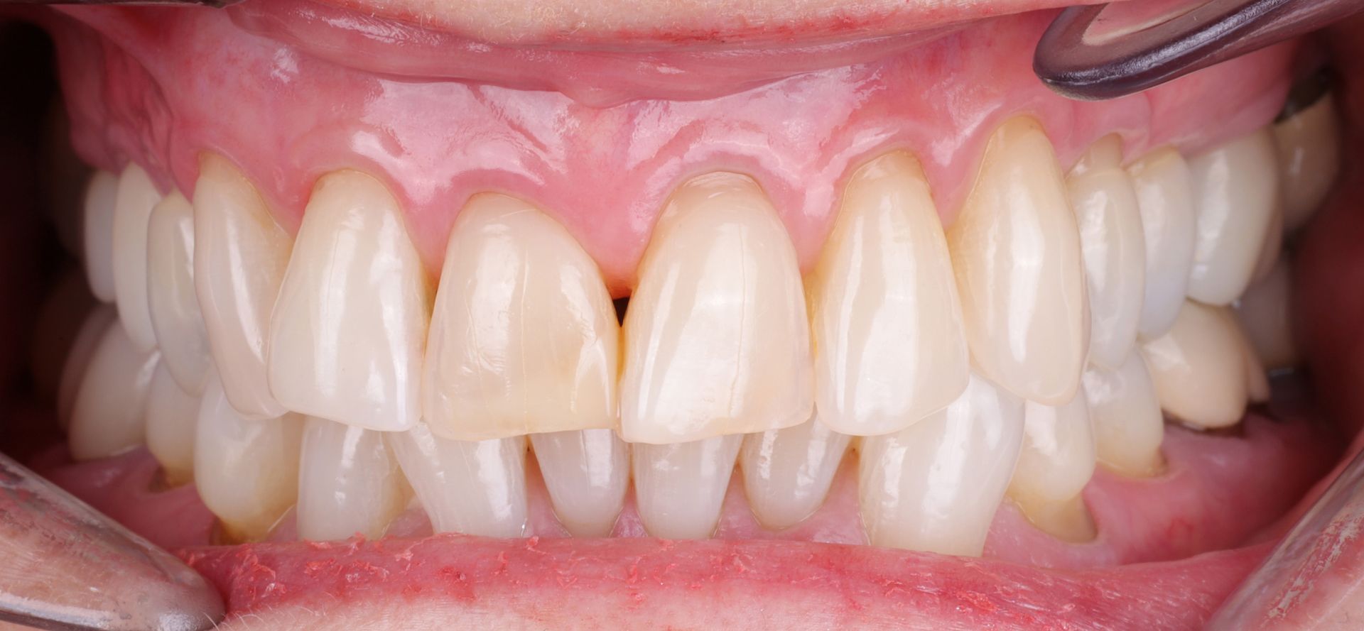 Before and after image of smile 