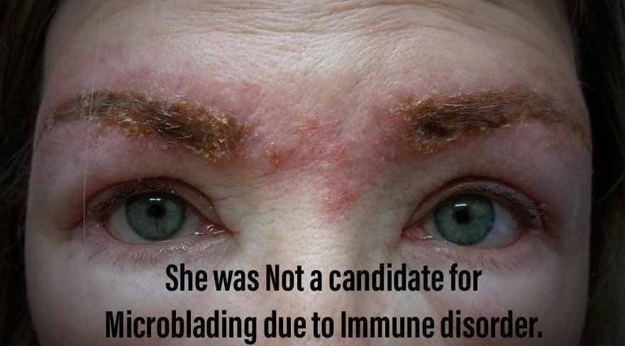 woman with peeling eyebrows