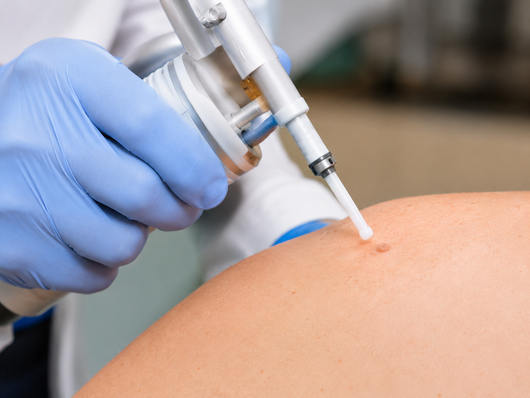 crioterapia dermatologica