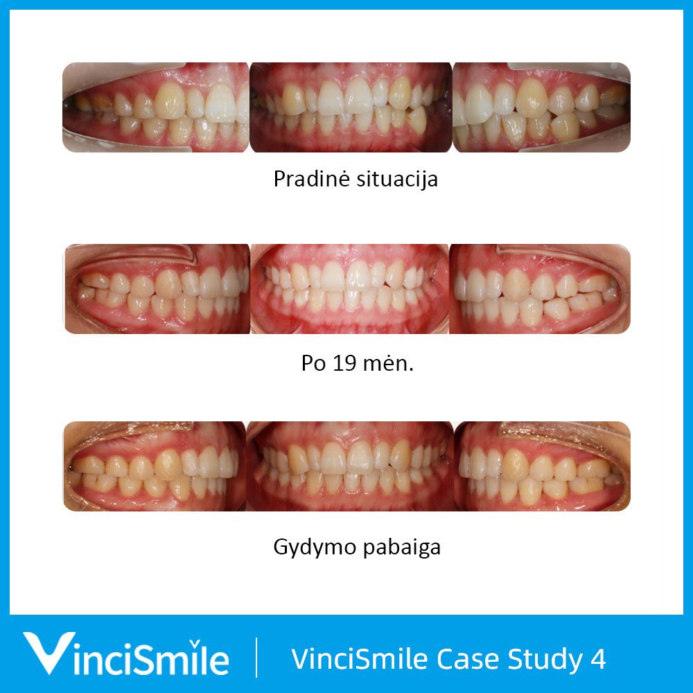 VinciSmile prieš ir po