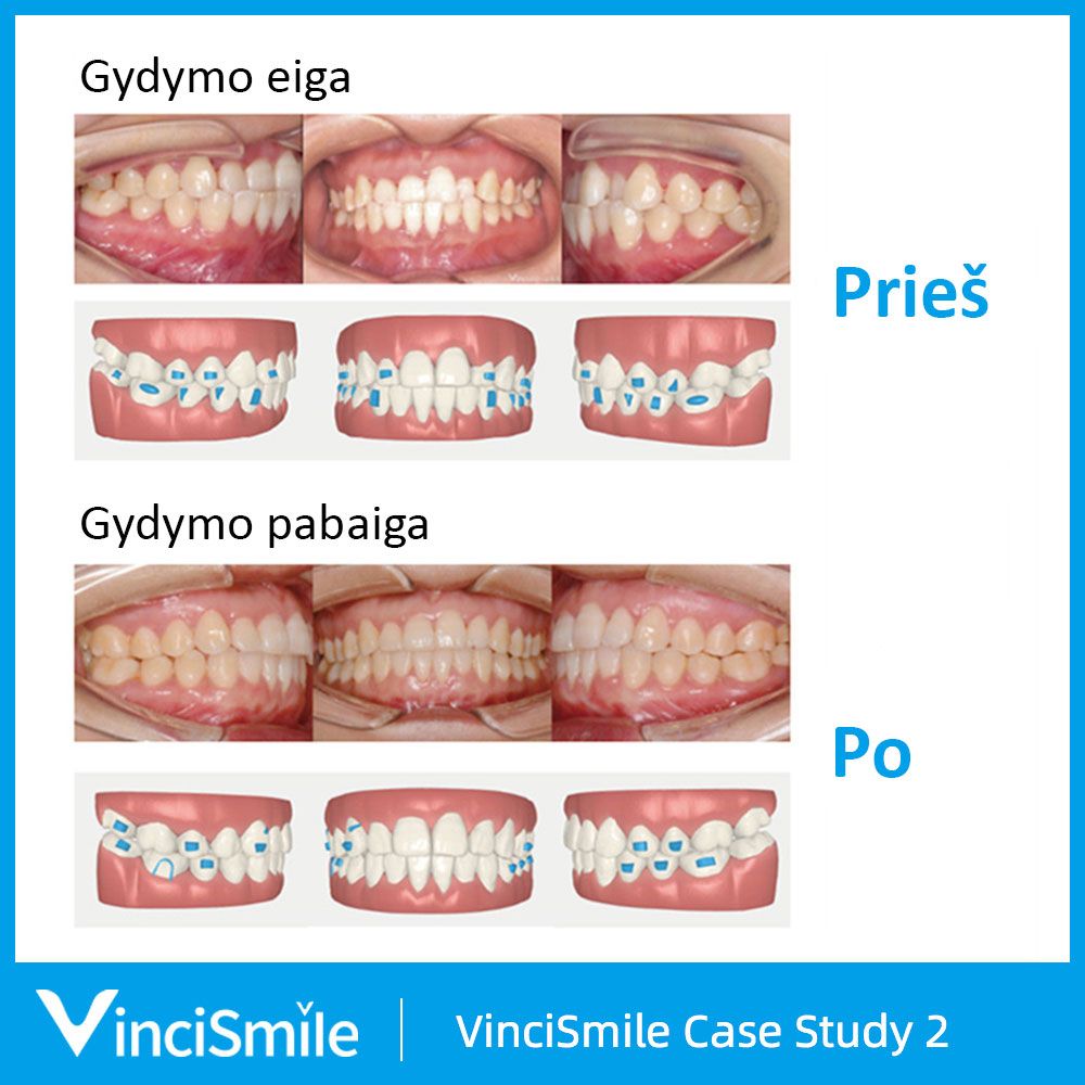 VinciSmile prieš ir po