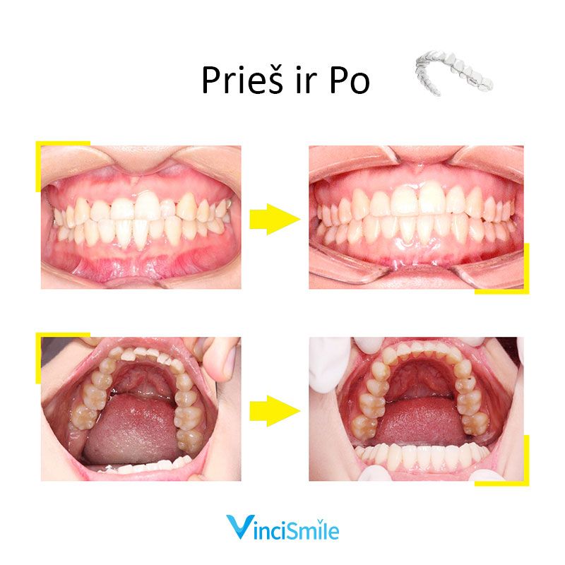 VinciSmile prieš ir po