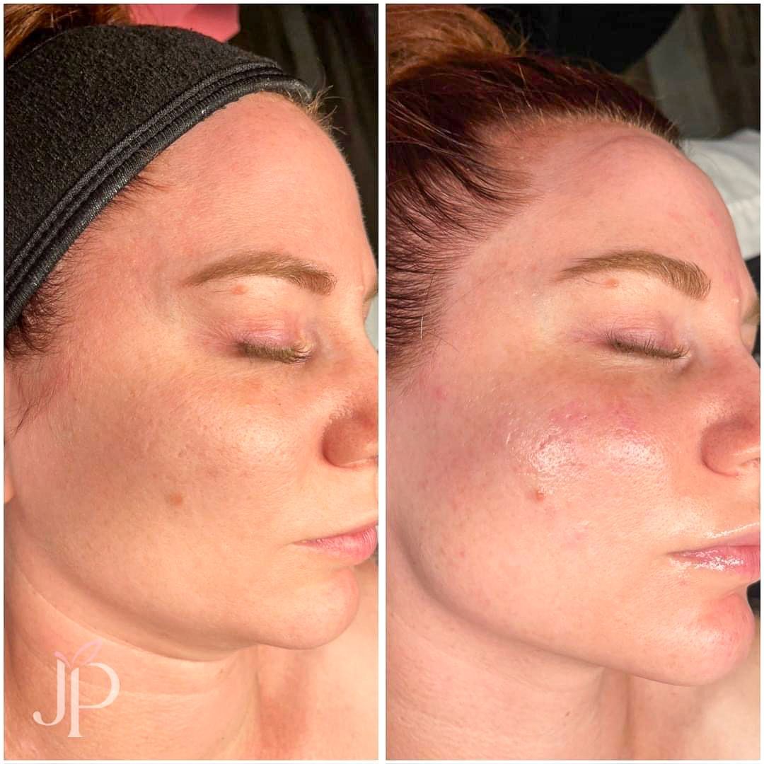 Before and after photos of a woman's face; right shows smoother skin.