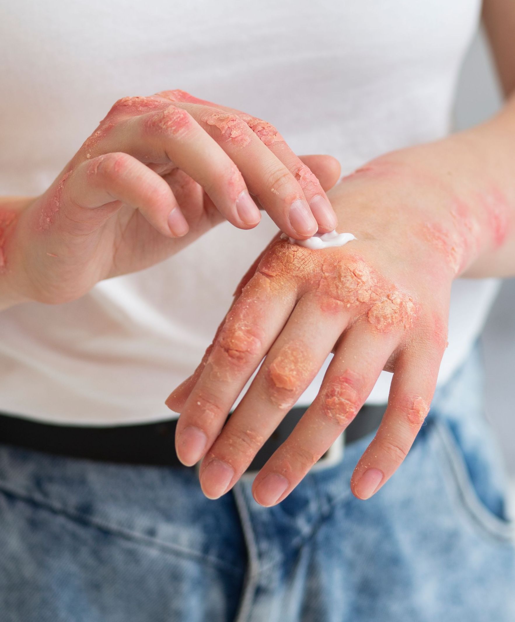 Médica para artrite psoriásica em Chapecó Médica para artrite psoriásica em Chapecó