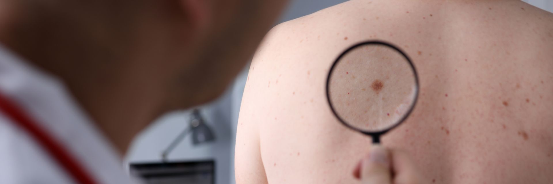 View of a blurred doctor checking a patient’s skin with a magnifying glass at askin cancer check-up.