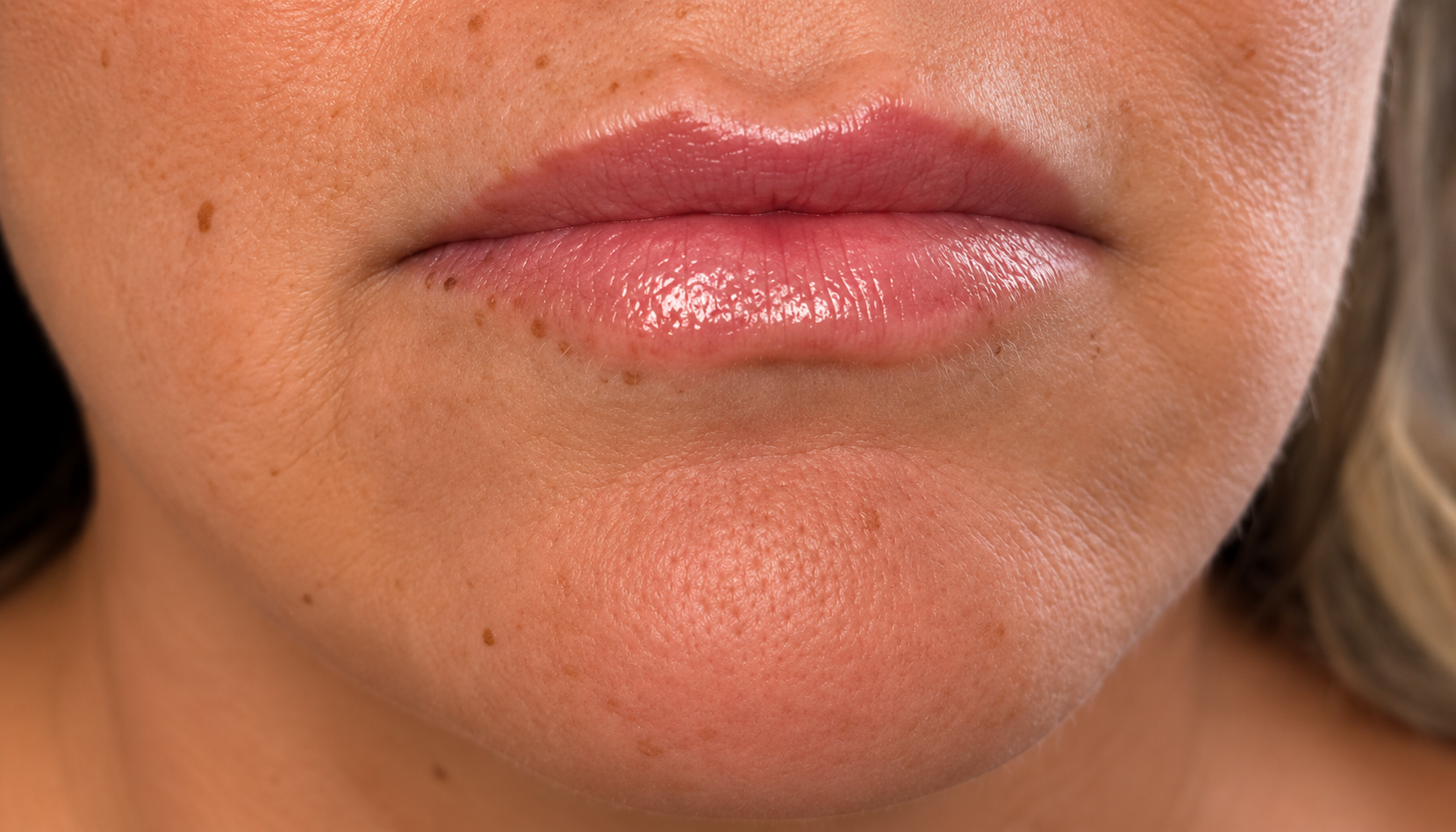 Lip Filler Before and After: A Natural Approach