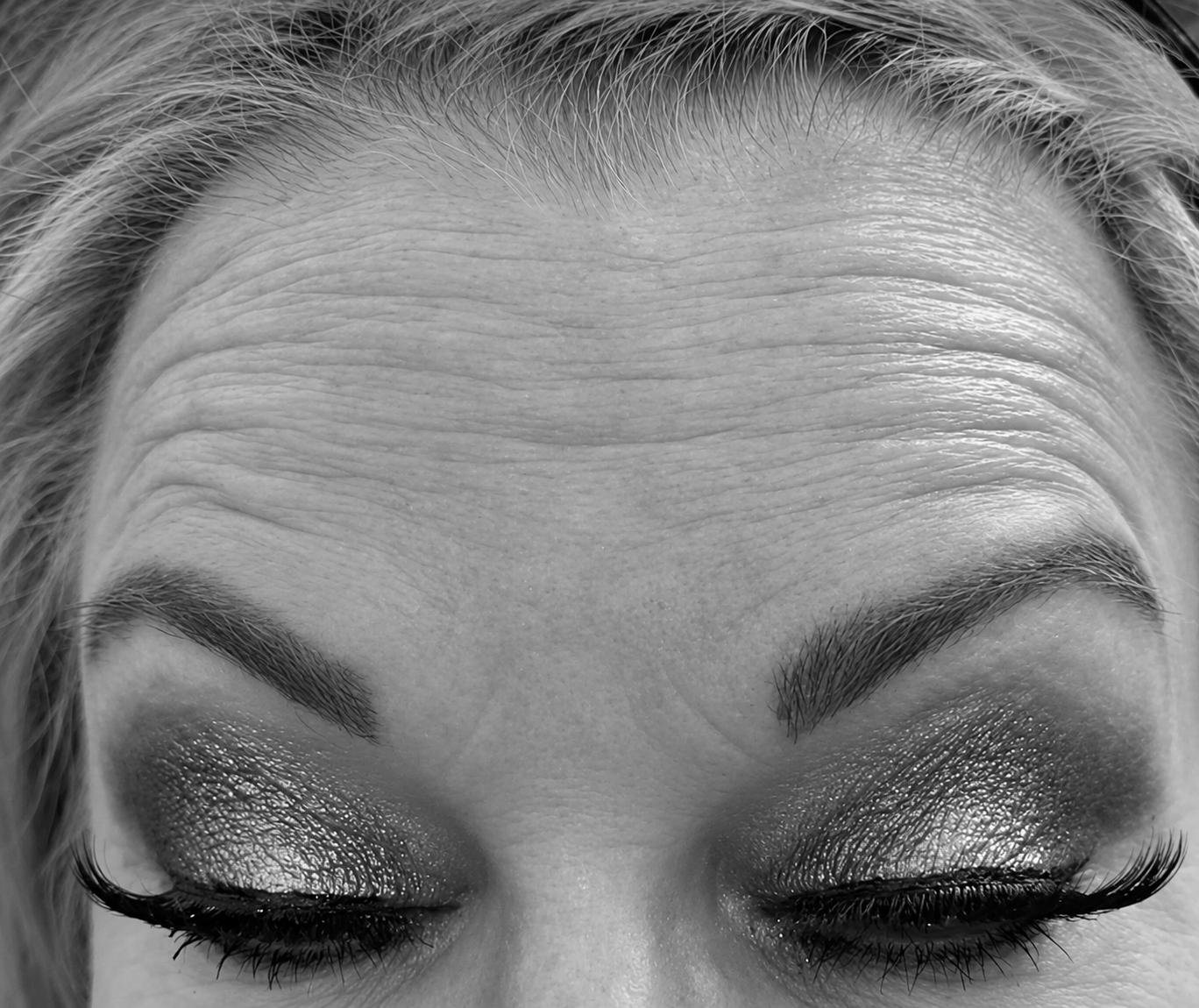 Close-up of before wrinkle relaxer treatment showing forehead with wrinkles.