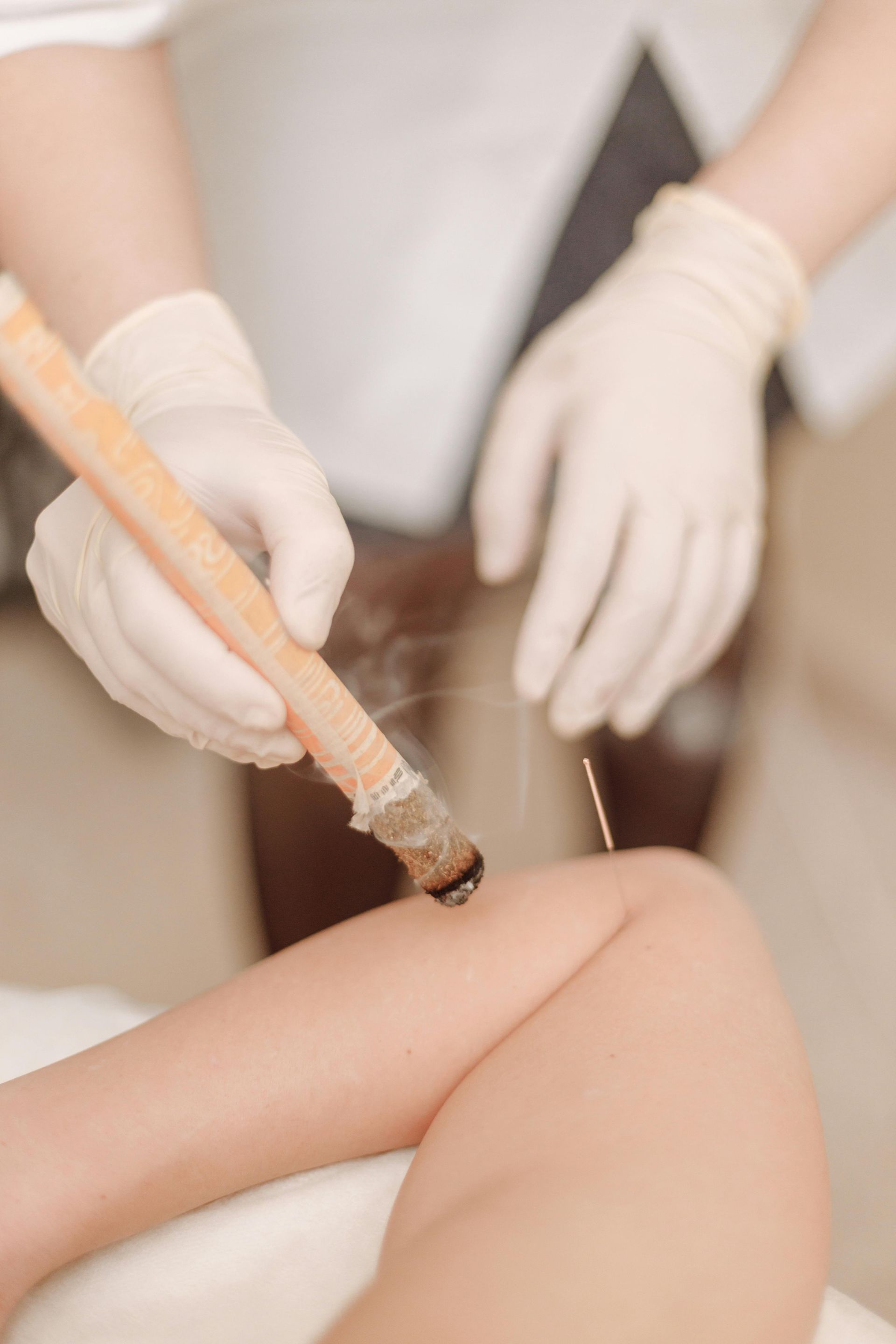 Acupuncture