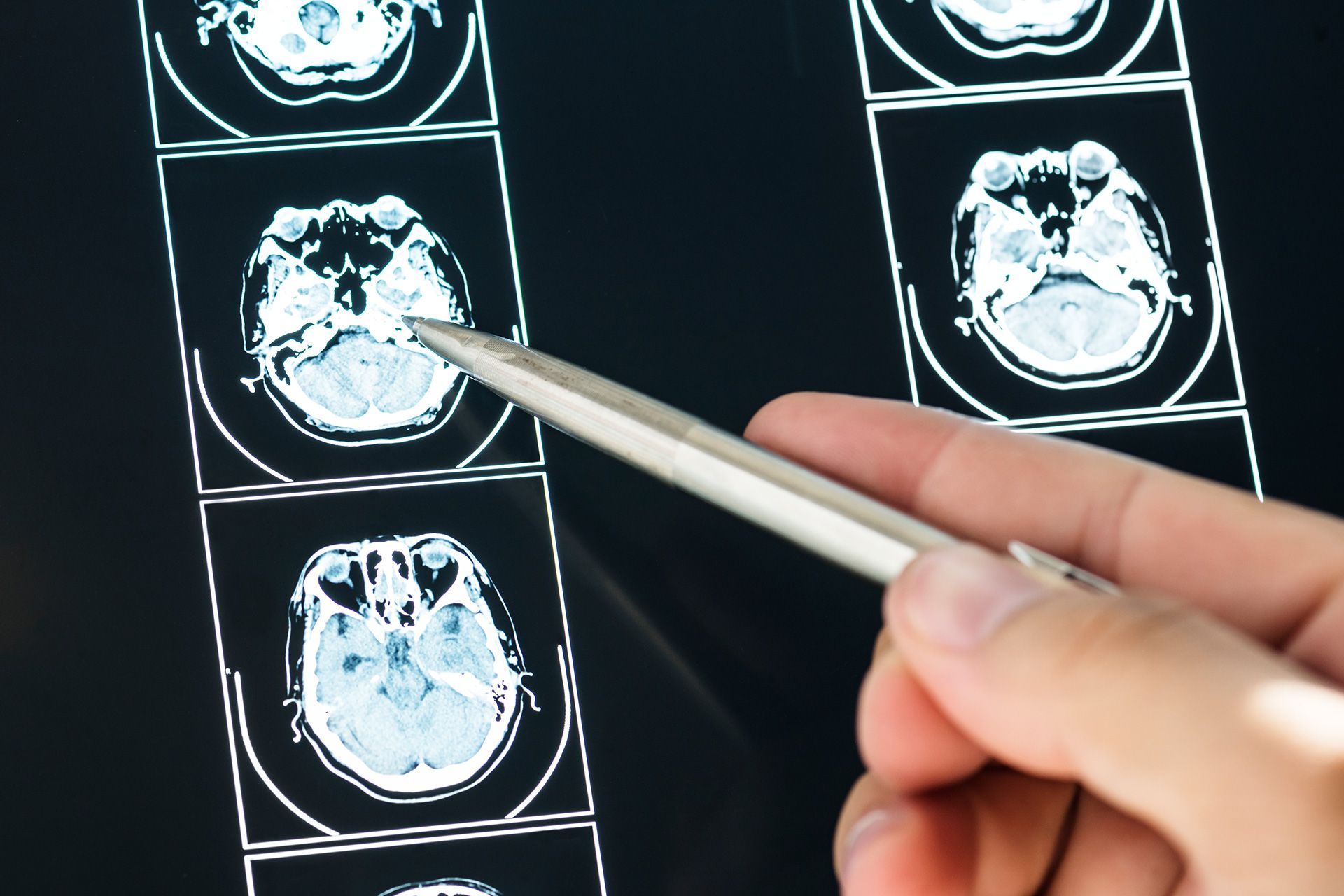 Doctor reviewing stroke diagnosis medical scans