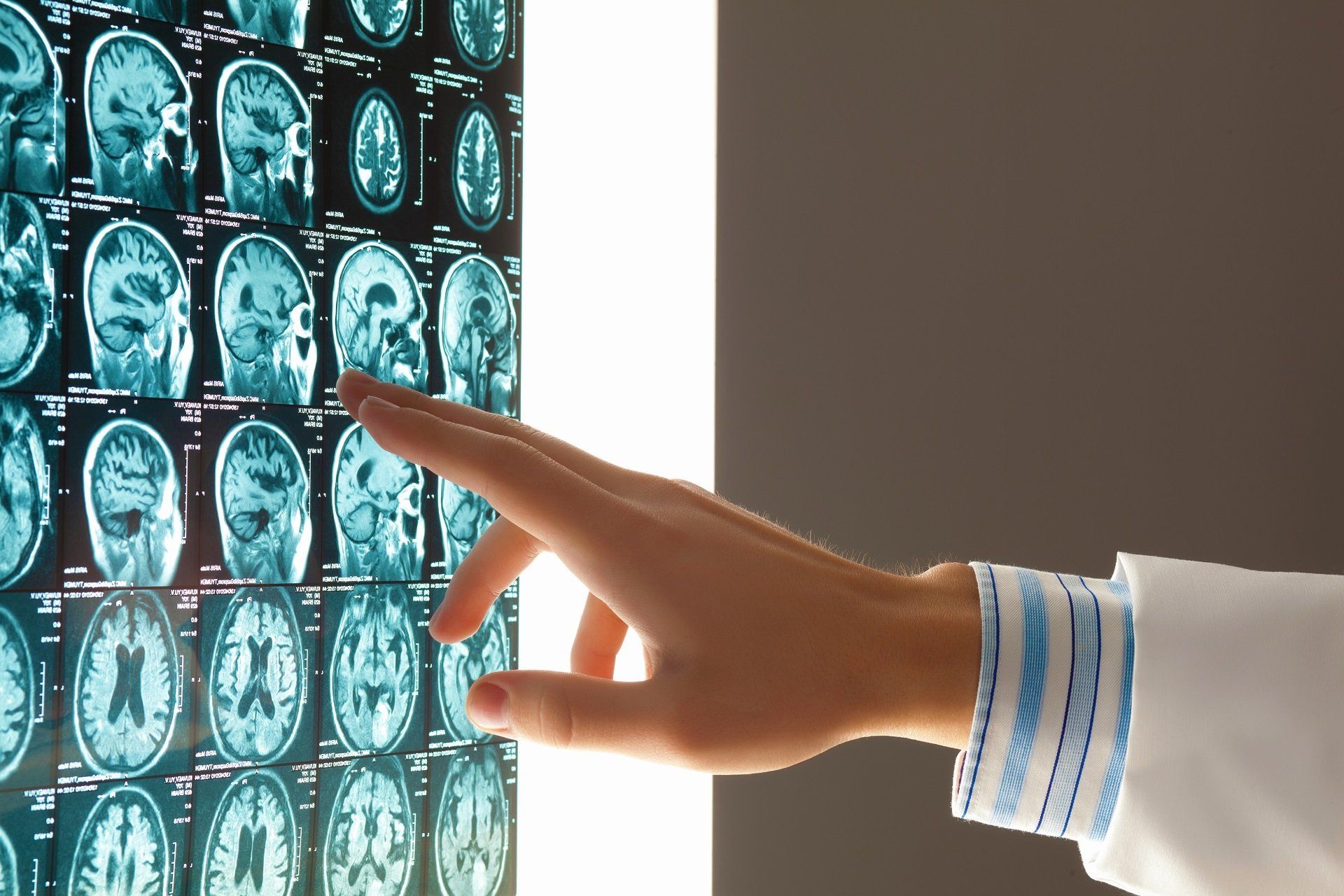 Stroke Mismanagement