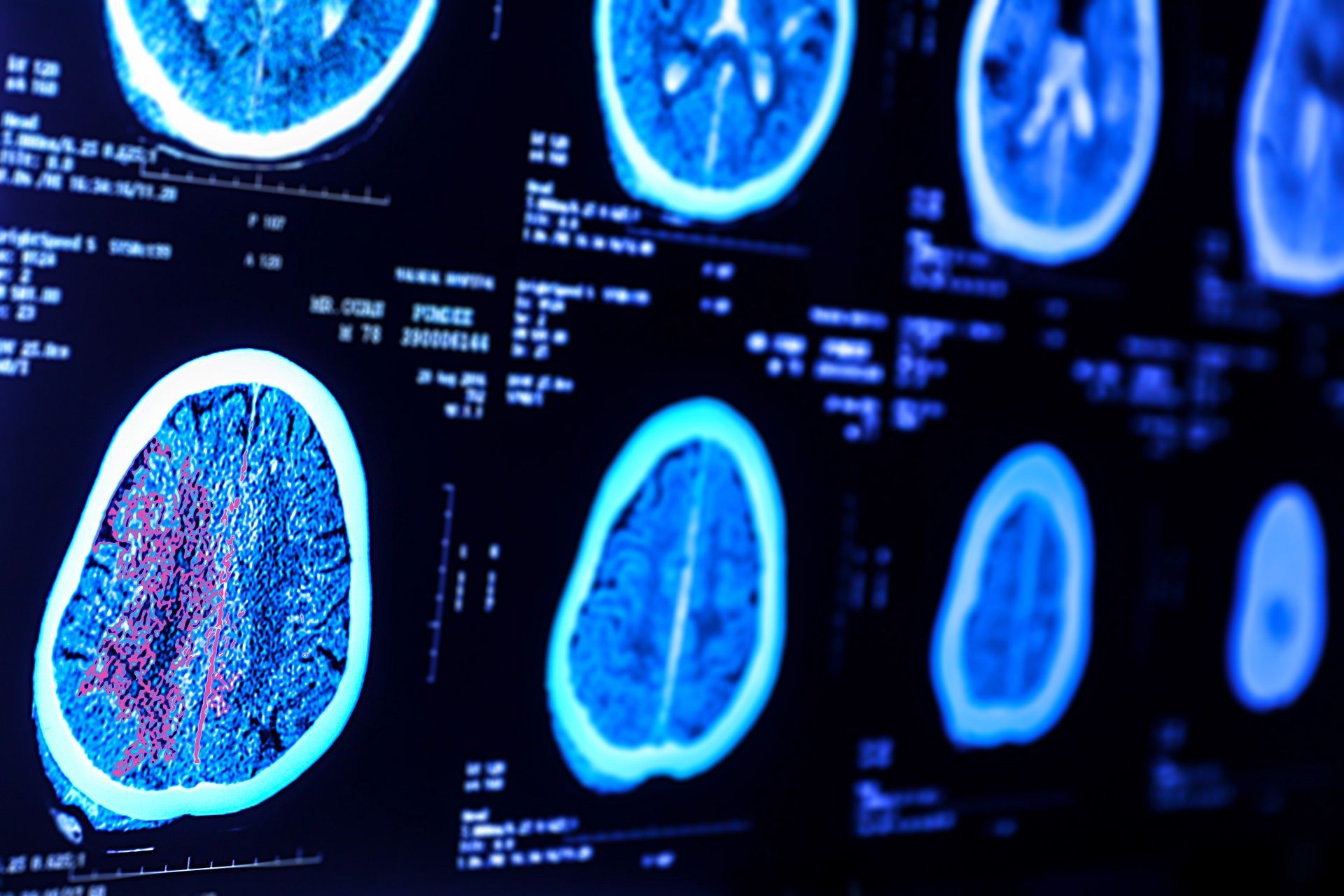Florida Cerebral Palsy Lawyer: Know Your Key Legal Rights!