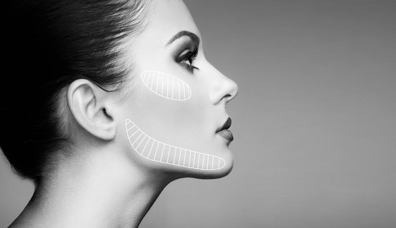 Genioplasty