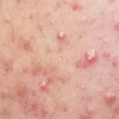 Active acne treated by Sciton BBL HERO at Skin & Soul Med Spa Seabrook TX
