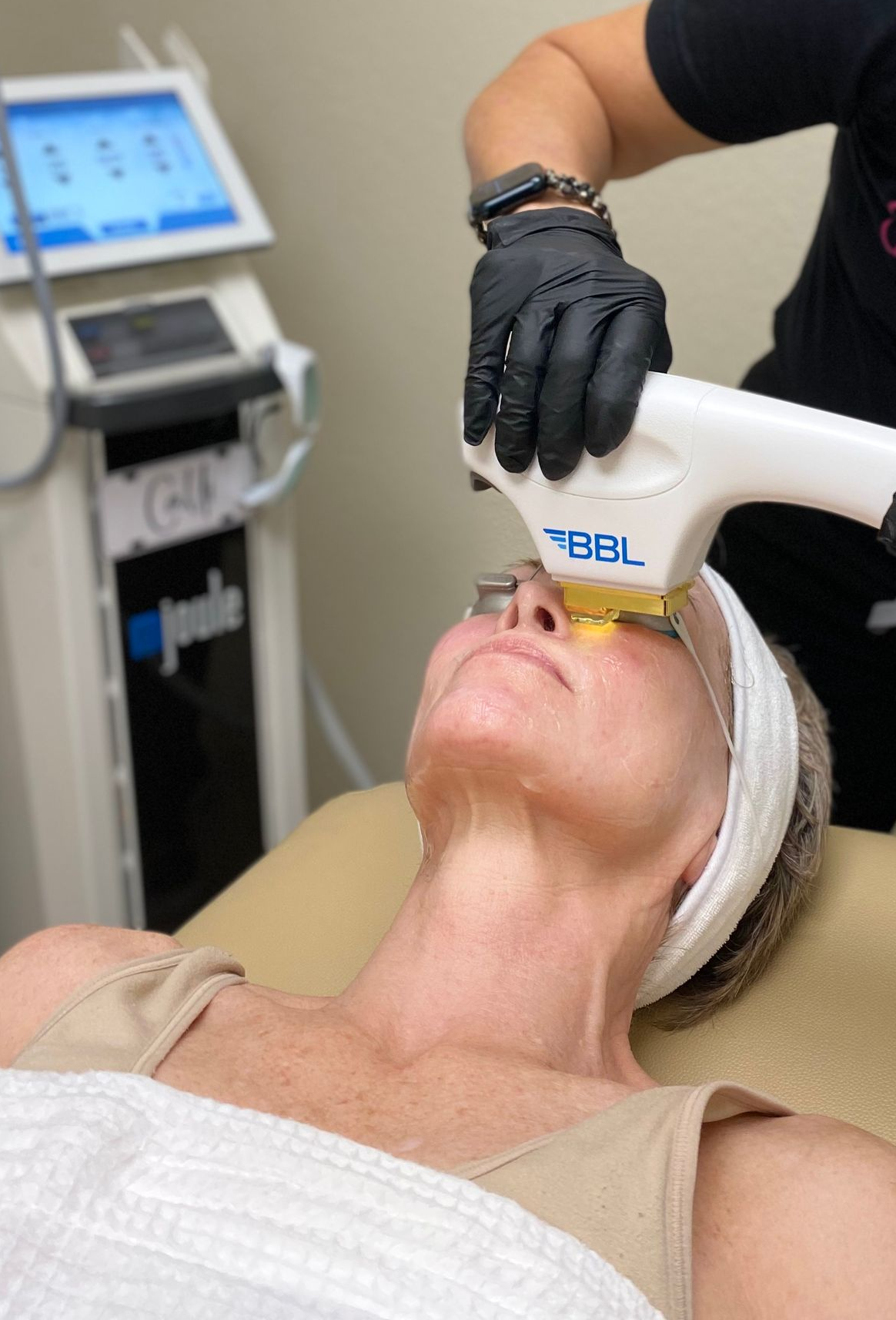 Sciton BBL HERO treatment for pigmentation and sun damage at Skin & Soul Med Spa Seabrook TX
