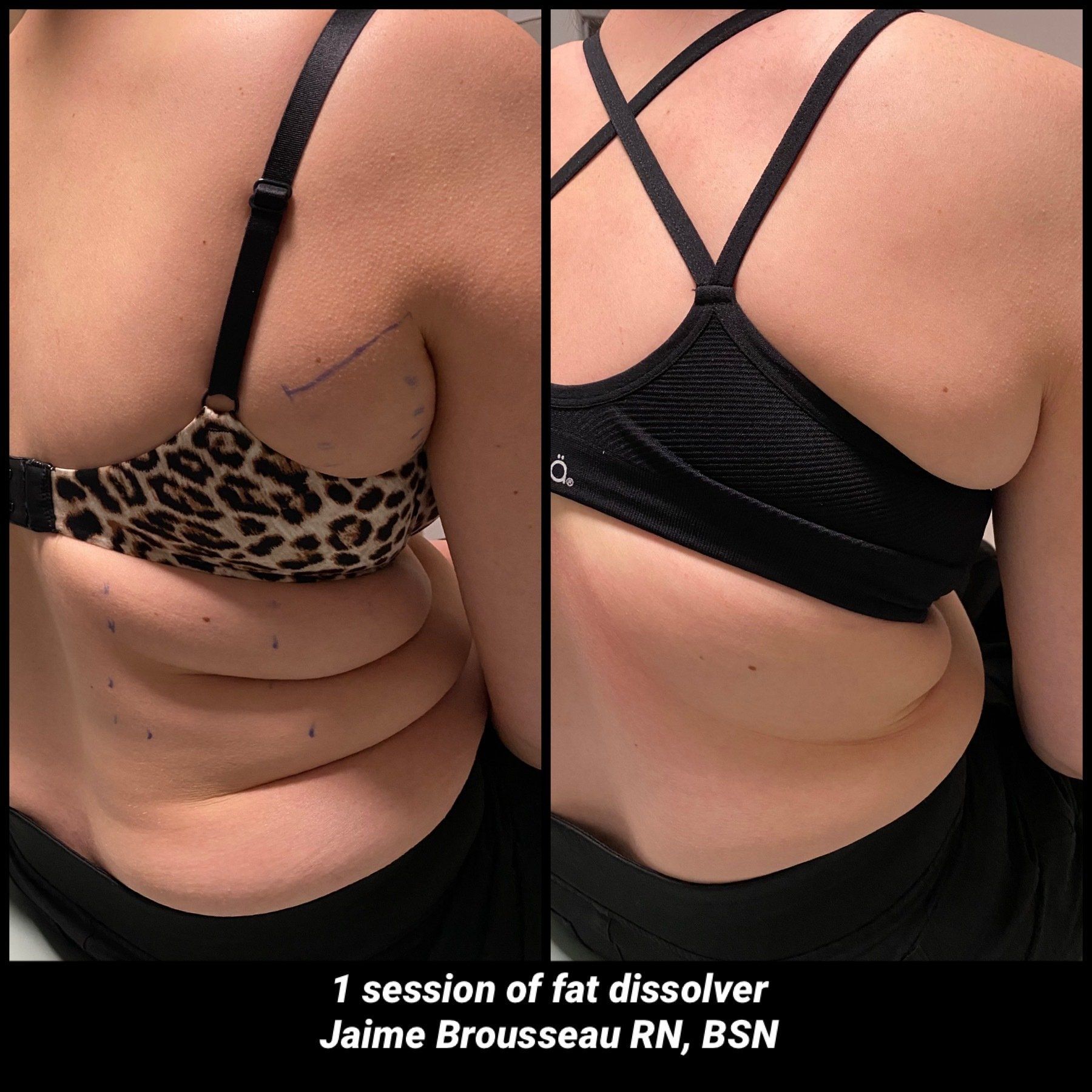 Kybella fat dissolver injection for submental fat at Skin & Soul Med Spa Seabrook TX