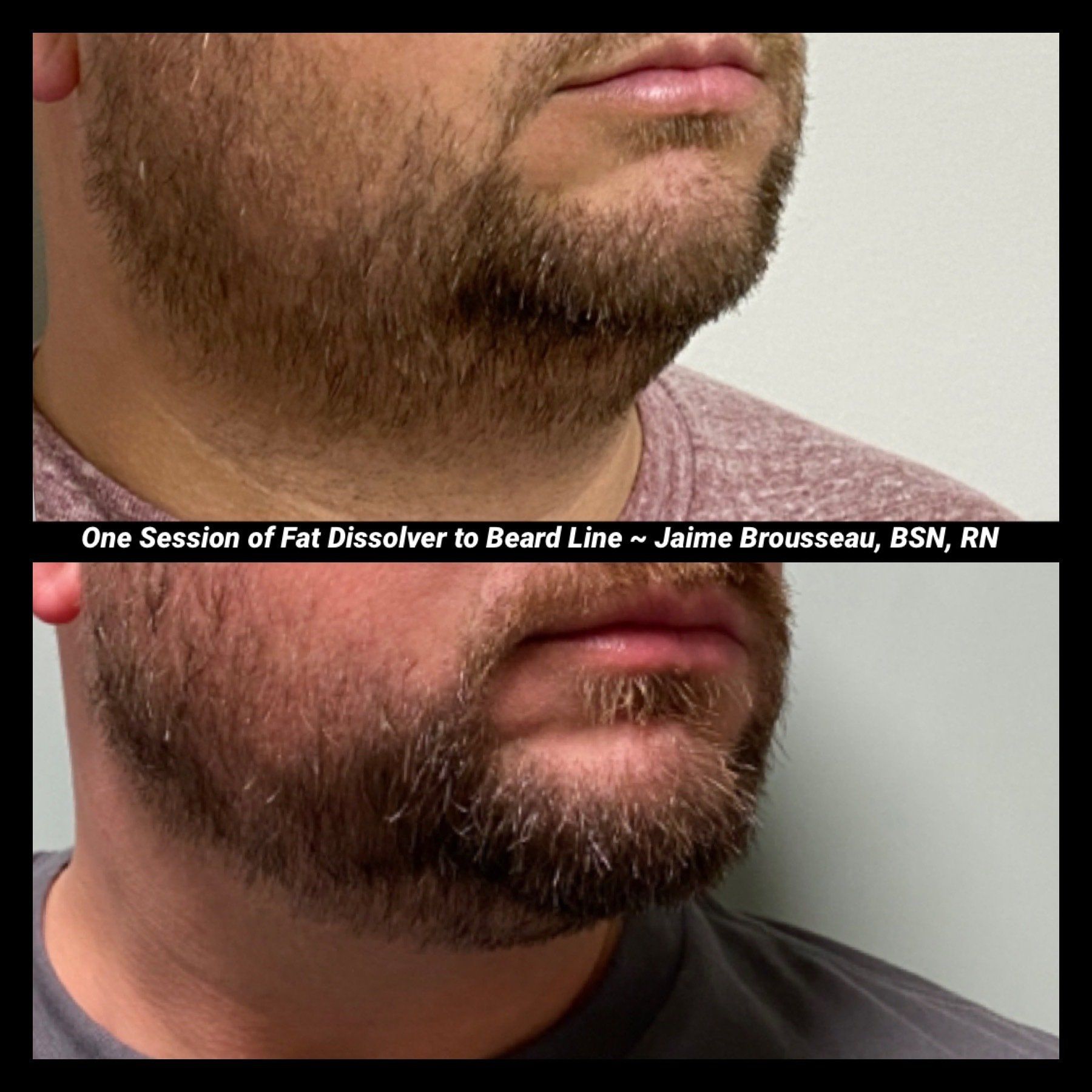 Kybella before and after results — submental fat reduction at Skin & Soul Med Spa