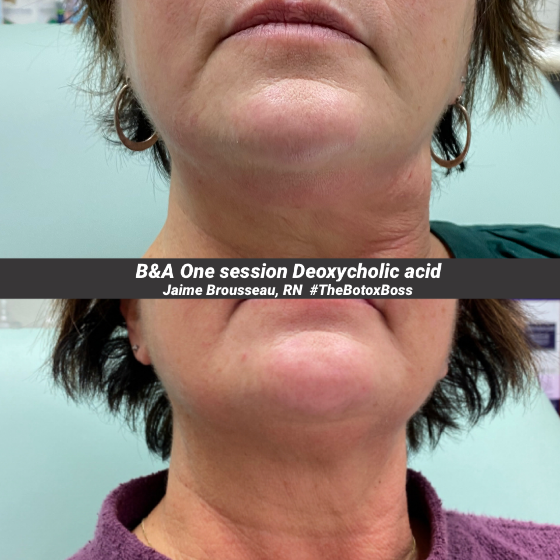 Kybella before and after results — submental fat reduction at Skin & Soul Med Spa