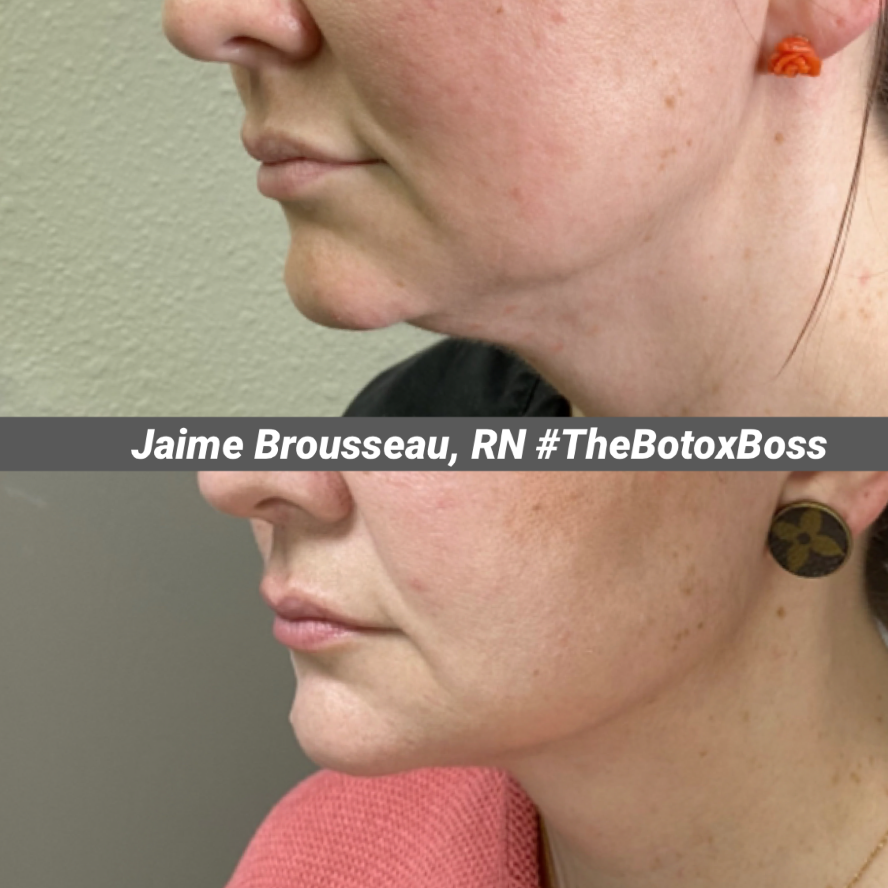Kybella before and after results — submental fat reduction at Skin & Soul Med Spa