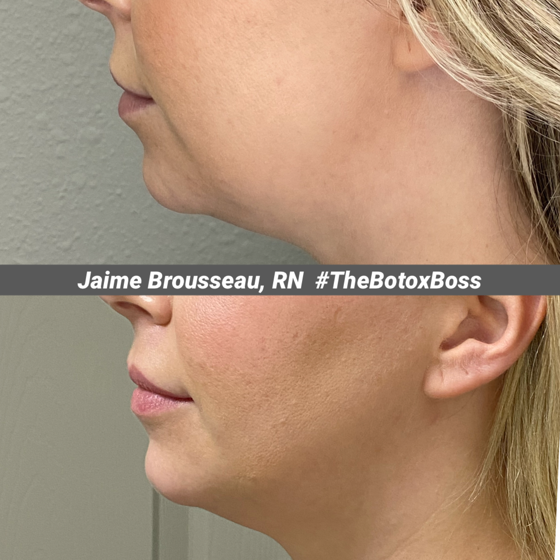 Kybella before and after results — submental fat reduction at Skin & Soul Med Spa