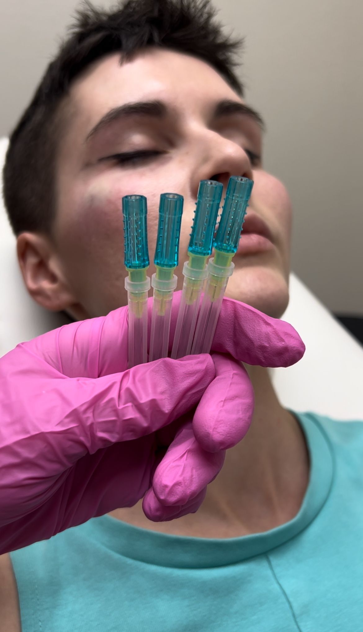 PDO thread lift procedure at Skin & Soul Med Spa near Clear Lake TX