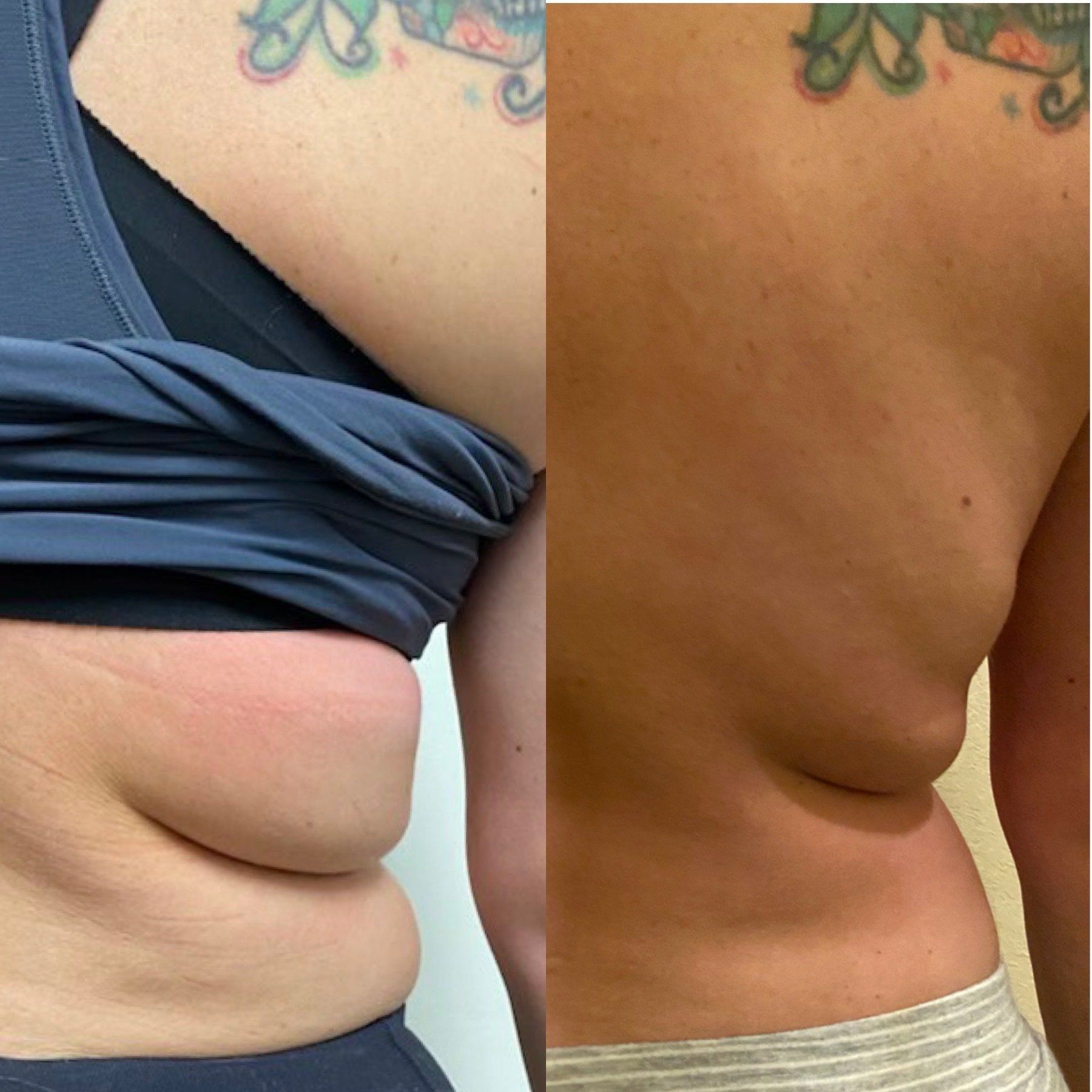 Kybella before and after results — submental fat reduction at Skin & Soul Med Spa
