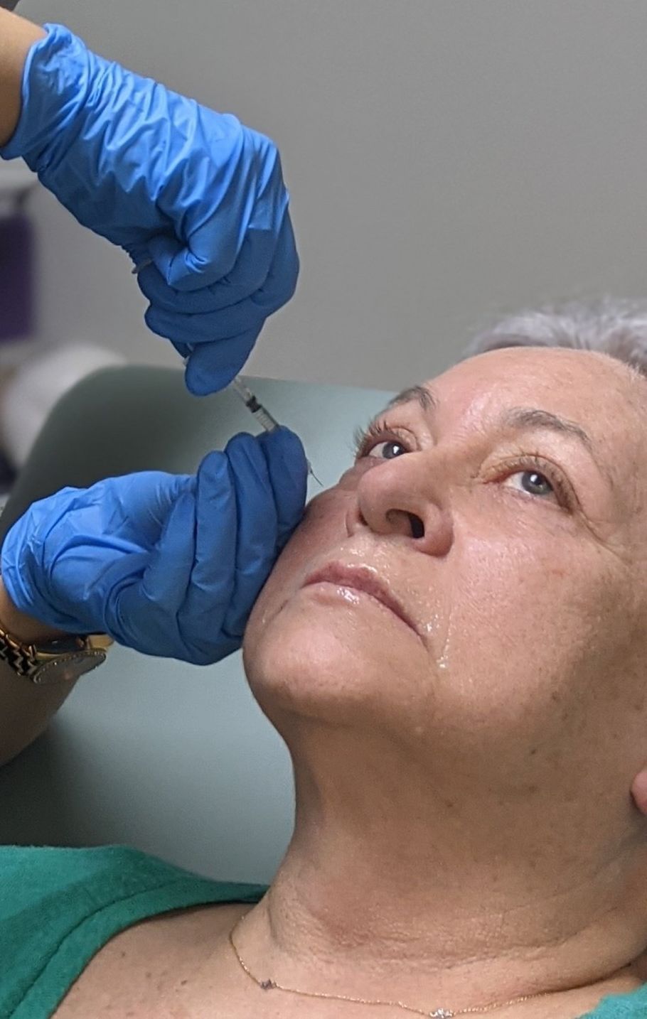 Dermal filler treatment at Skin & Soul Med Spa in Seabrook TX