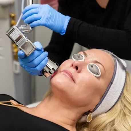 MicroLaserPeel treatment at Skin & Soul Med Spa Seabrook TX