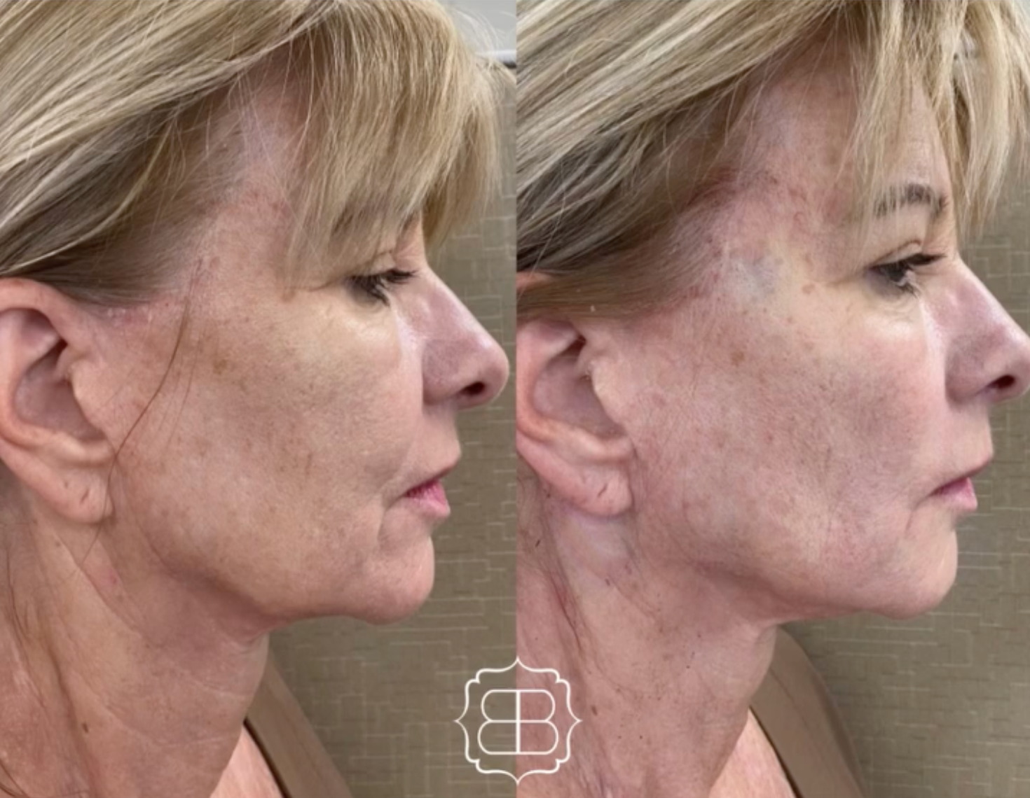 PDO thread lift before and after results at Skin & Soul Med Spa Seabrook TX