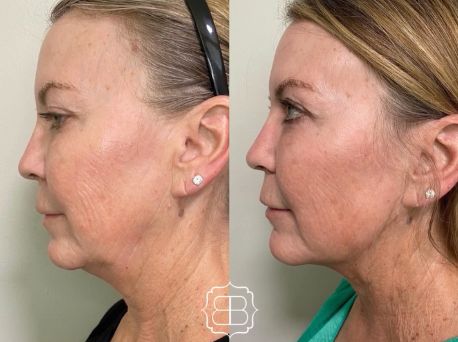 PDO thread lift before and after results at Skin & Soul Med Spa Seabrook TX