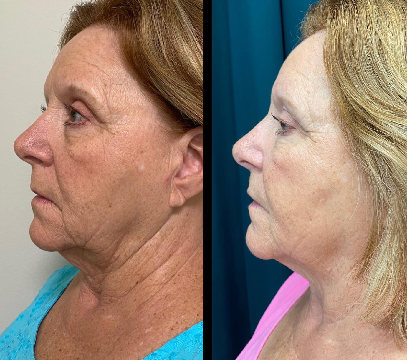PDO thread lift before and after results at Skin & Soul Med Spa Seabrook TX