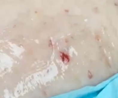 Cherry angiomas treated by Sciton BBL HERO at Skin & Soul Med Spa Seabrook TX