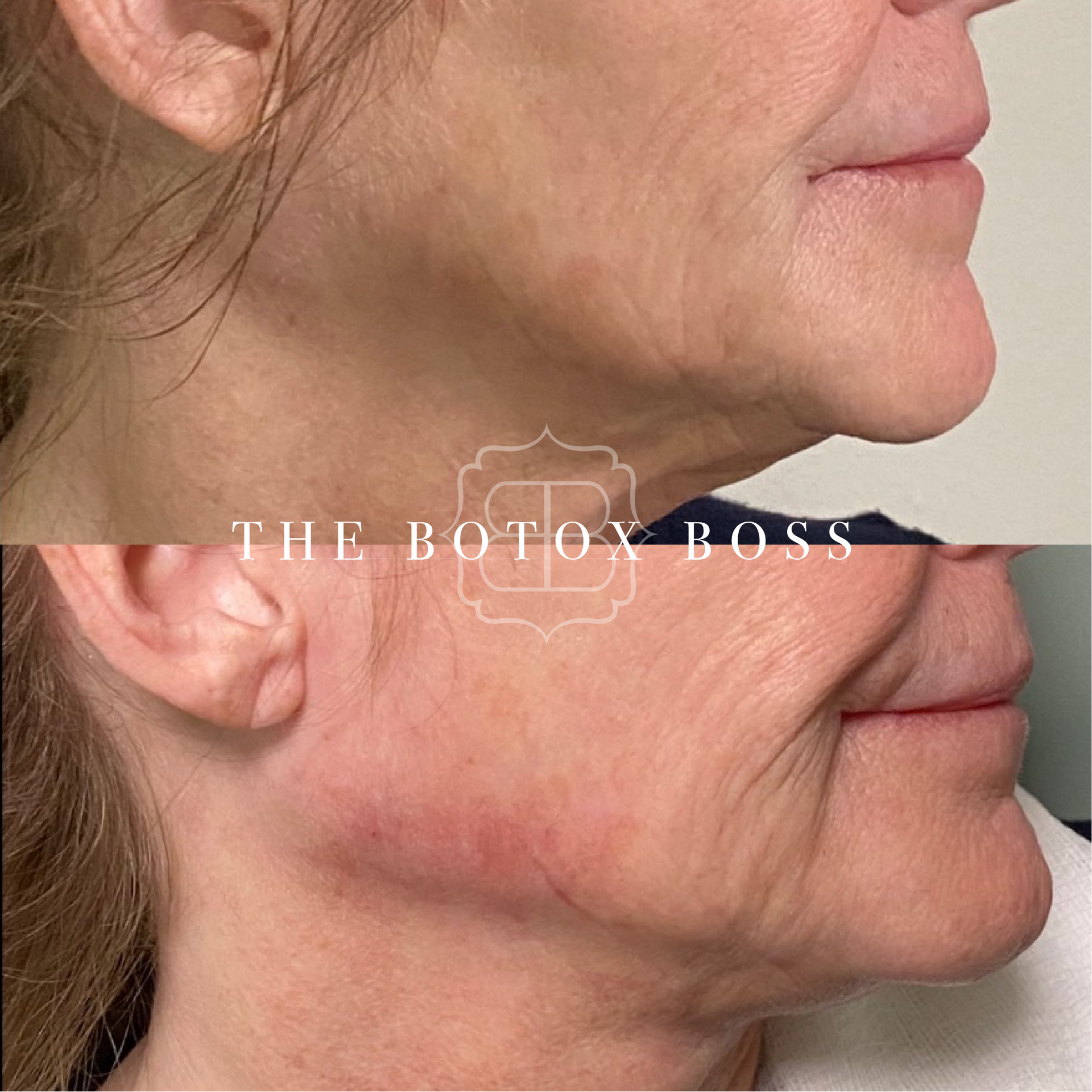 Sculptra facial volume restoration before and after at Skin & Soul Med Spa