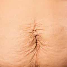 Loose or sagging skin treated by Sciton BBL HERO at Skin & Soul Med Spa Seabrook TX