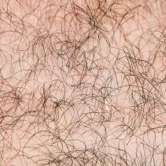 Excess hair treated by Sciton BBL HERO at Skin & Soul Med Spa Seabrook TX