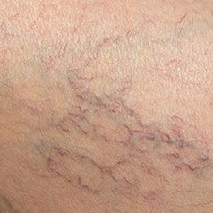 Small vessels treated by Sciton BBL HERO at Skin & Soul Med Spa Seabrook TX