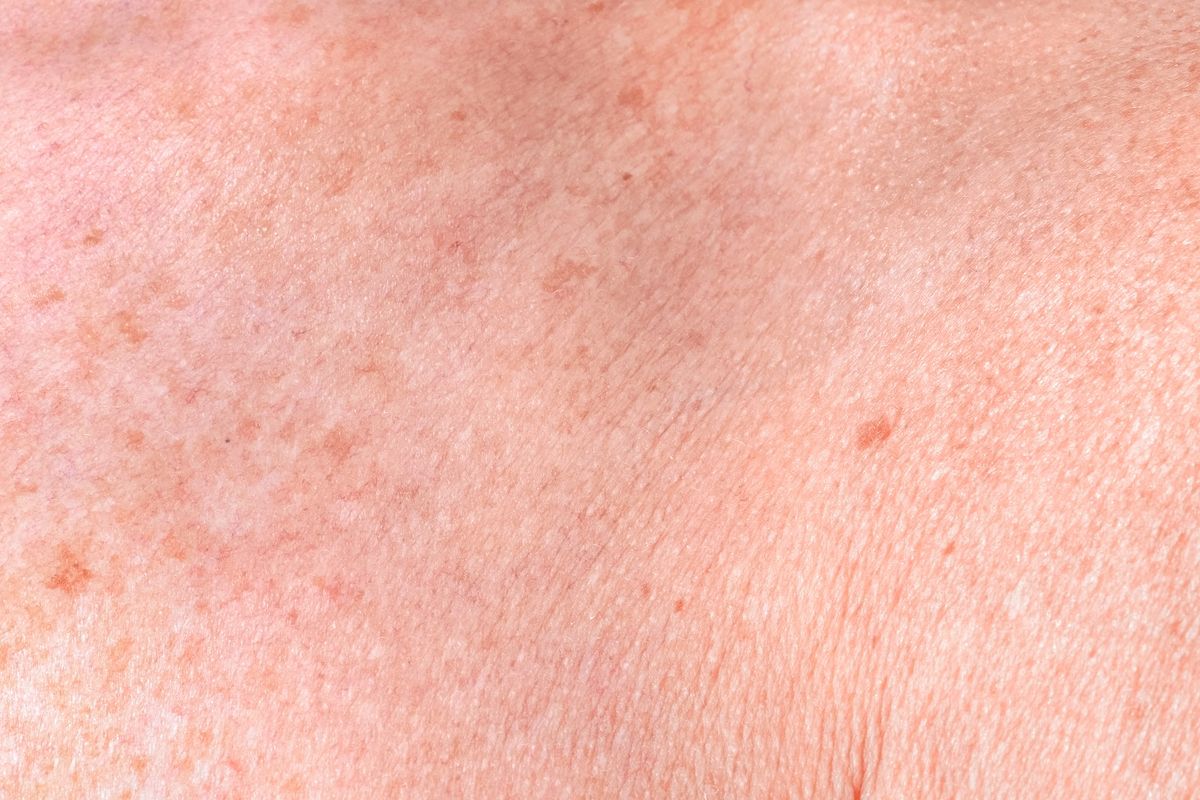 Signs of Aging treated by Sciton BBL HERO at Skin & Soul Med Spa Seabrook TX