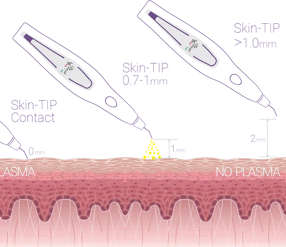 Diagram showing how Plexr plasma energy works to tighten skin at Skin & Soul Med Spa Seabrook TX