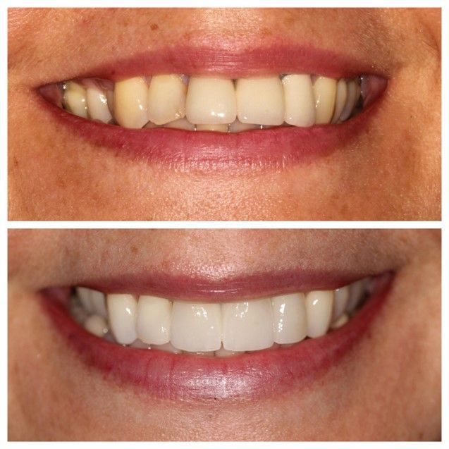 Before and after images of porcelain crowns, demonstrating the benefits for patients at Hampstead Clinic