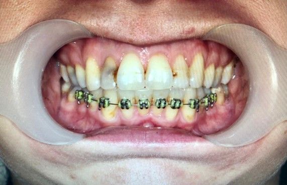 Close-up before photos of composite bonding veneers, showcasing smile enhancements at Hampstead Clinic