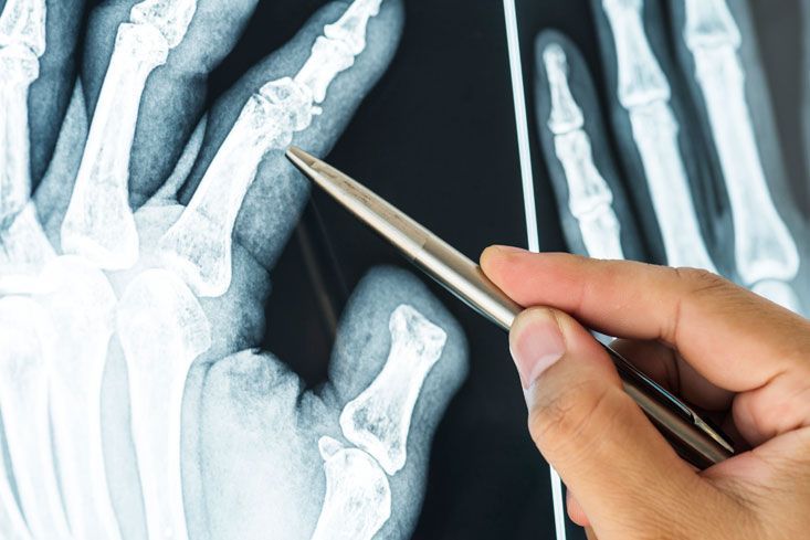 CLINICA DE LESIONES DERMICAS PROMEDICA  -  FRACTURAS