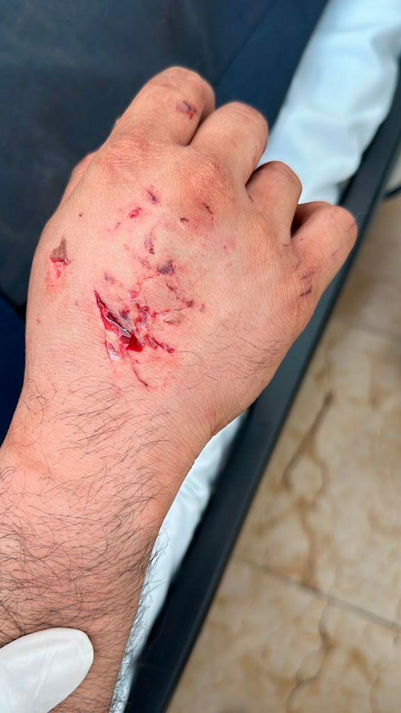 LESIONES