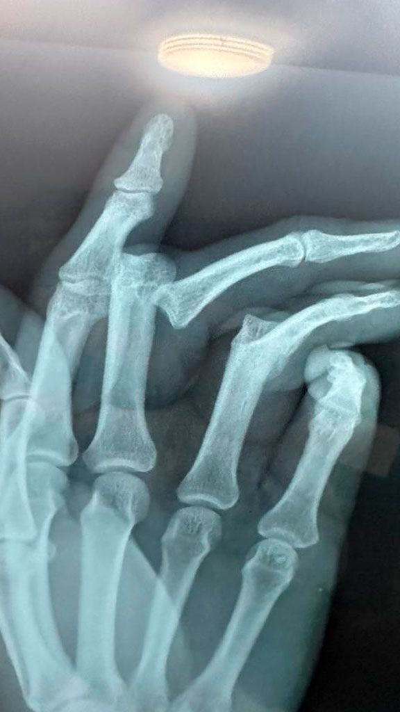 CLINICA DE LESIONES DERMICAS PROMEDICA  -  HERIDAS CORTANTES