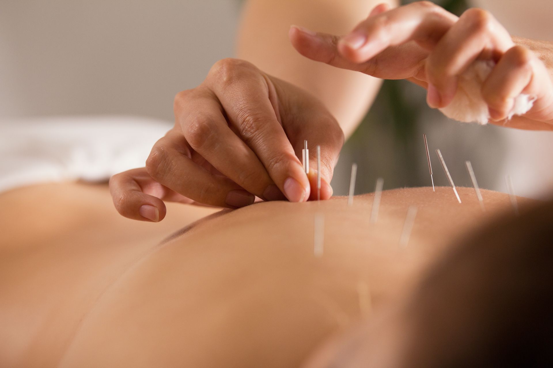 Dry Needling