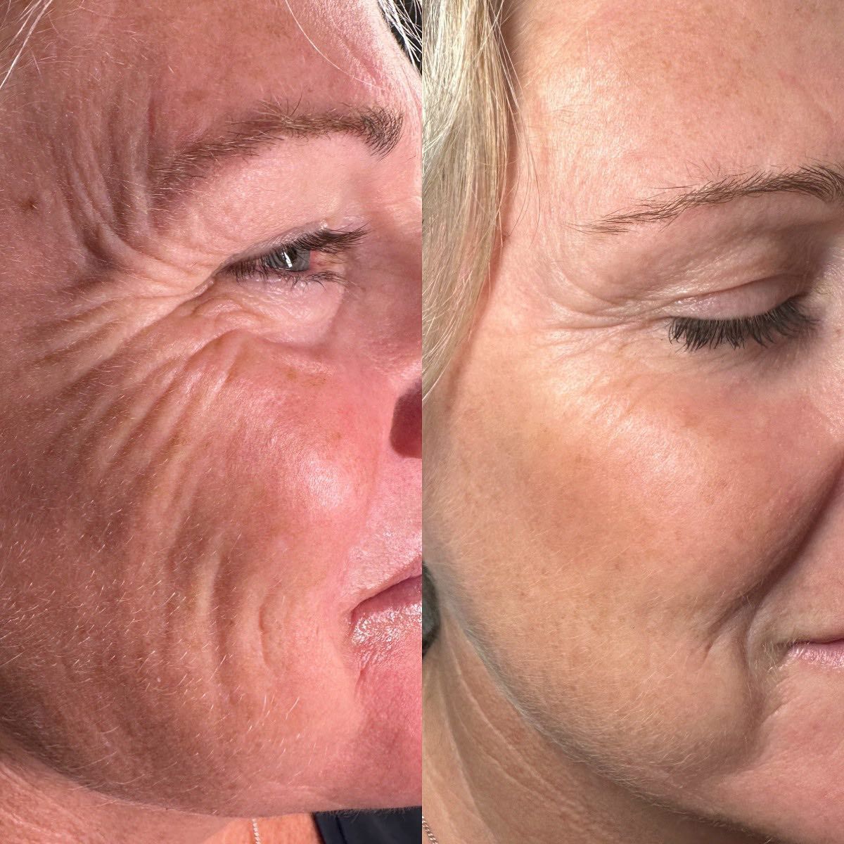 Skin Needling in Forster Tuncurry | Vanity Skin and Beauty