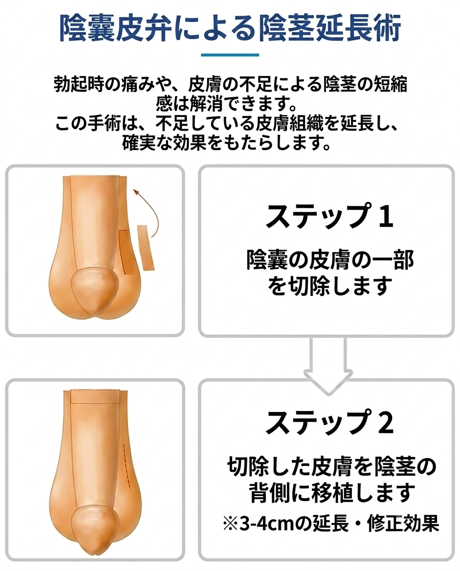 ユロジン男性クリニック 釜山西面の陰嚢皮弁手術の手順