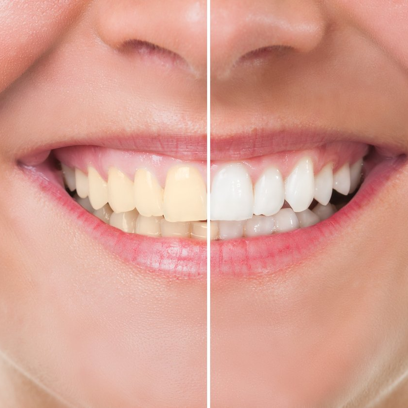 before and after teeth whitening | Brighten your smile with teeth whitening in Overland Park 66221.